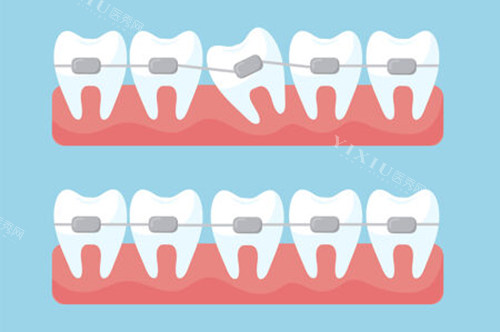 矫牙后为何牙缝无法完全闭合？医师详解可能的原因！(图3)