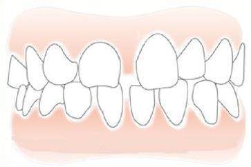 矫牙后为何牙缝无法完全闭合？医师详解可能的原因！(图2)