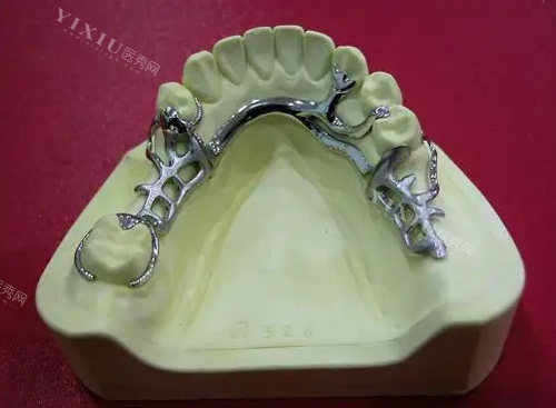 仿生牙和活动假牙有什么区别？仿生牙怎么安装的？一篇文章告诉你所有答案！(图3)