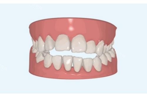 牙齿畸形模型图