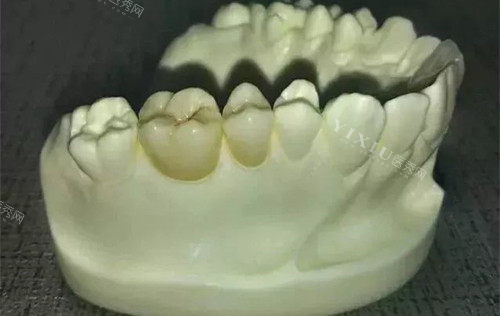 阿曼吉尔巴赫全瓷牙质量怎么样？价格2000敢用吗？详细官方介绍都在这里！(图2)