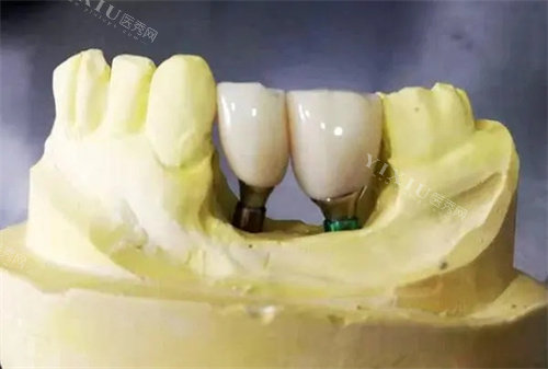 阿曼吉尔巴赫全瓷牙质量怎么样？价格2000敢用吗？详细官方介绍都在这里！(图3)