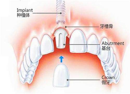 宝鸡岐山做种植牙哪家好？本地人推荐种植选这五家可信赖！(图1)