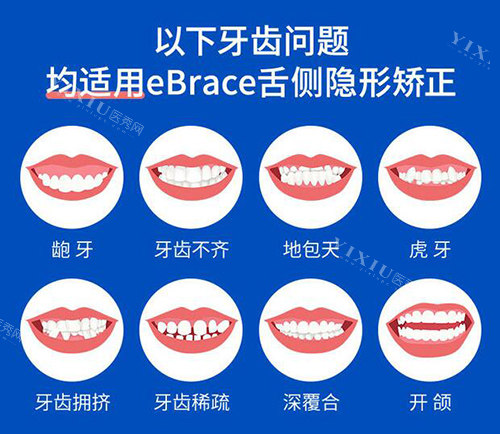 ebrace舌侧矫正多少钱？4万元左右！将适应症/正畸优势/改善注意事项揭秘！-医秀网