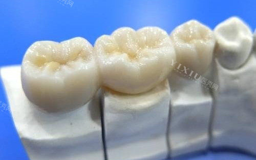 做3M拉瓦全瓷牙费用得好几万？为什么这么贵？价格浮动大不一定是这么多！(图1)