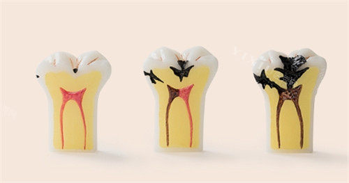 两颗牙齿中间缝隙黑了一定要注意，龋齿不清理两颗牙齿都得坏！(图4)