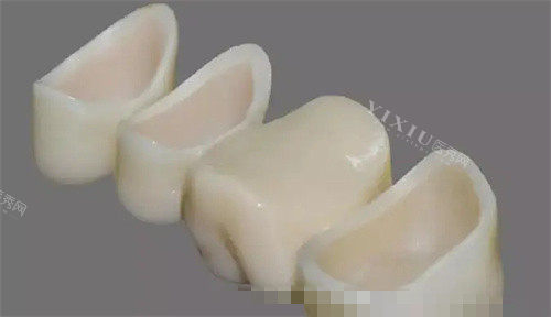 做3M拉瓦全瓷牙费用得好几万？为什么这么贵？价格浮动大不一定是这么多！(图2)