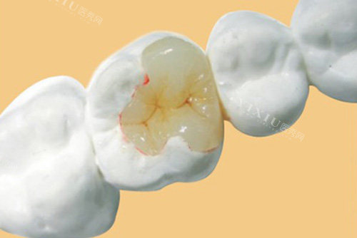 两颗牙齿中间缝隙黑了一定要注意，龋齿不清理两颗牙齿都得坏！(图3)