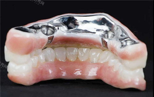 peek义齿支架和纯钛哪个好？区别对比，舒适度／美观度／质量／优缺点分析！(图3)