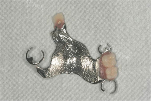 peek义齿支架和纯钛哪个好？区别对比，舒适度／美观度／质量／优缺点分析！(图1)