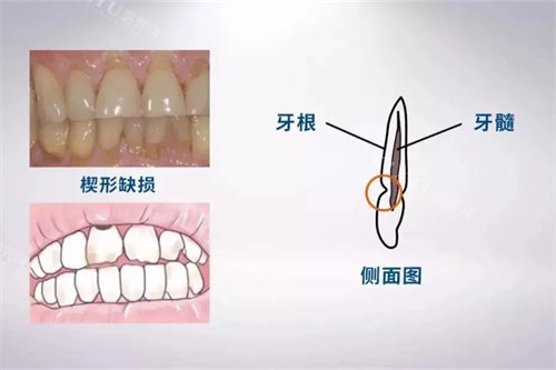 楔状缺损位置示意图