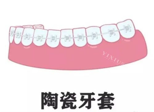 正畸小课题：今天分享的是日本拓美陶瓷自锁托槽优势特点／口碑评价~(图3)