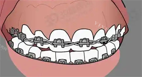 Shinye新亚牙齿矫正好不好？有什么优势呢？(图2)