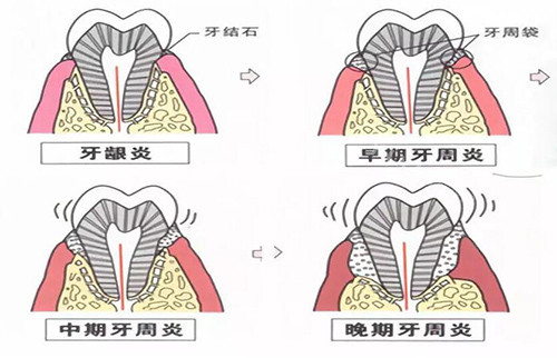 牙龈炎不同程度卡通图