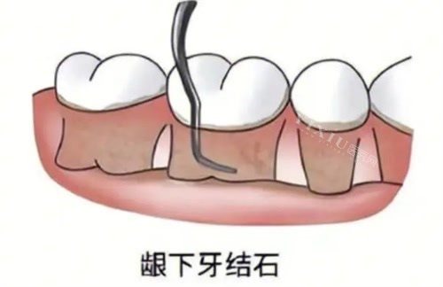 龈下刮治卡通图