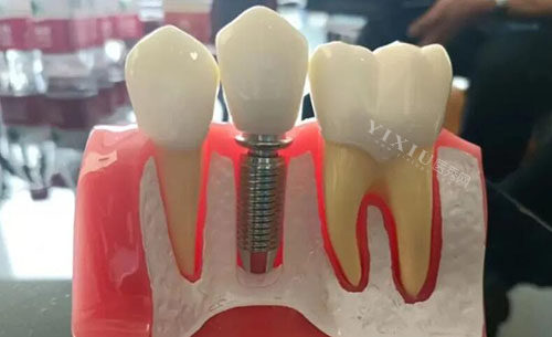 杭州桐庐种植牙好口腔排名分享，启典／尚雅／众乐口腔技术好千万别错过！(图4)