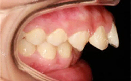 下颌后缩做矫正得多少钱？便宜5000+贵的15000+来看看有什么区别！(图2)