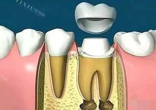 根管治疗后带牙冠