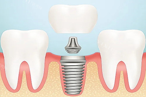 不再犹豫！北京东城区牙齿种植价格表公开，看这里，提前了解种牙一颗多少钱(图4)