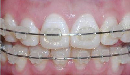 正畸小课堂：上牙扩弓下牙会随之变化吗？点击了解口腔正畸知识解析(图2)