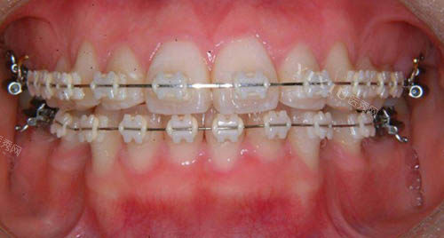 ​十七岁整牙大概需要多少钱？传统矫正10000+／隐形矫正20000+／陶瓷托槽15000+(图1)