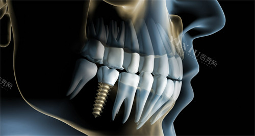 植骨和种植牙可以同时进行吗？在符合一定条件的情况下采用即刻或早期植骨结合种植的方案是可行的！(图2)