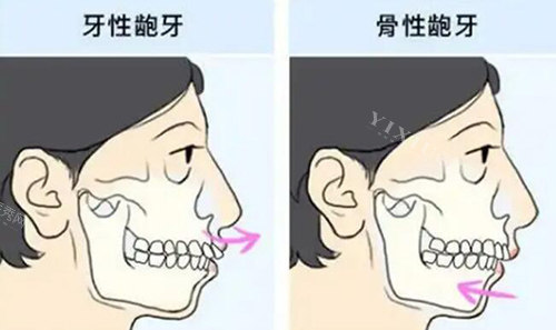 骨性龅牙齿性龅牙对比