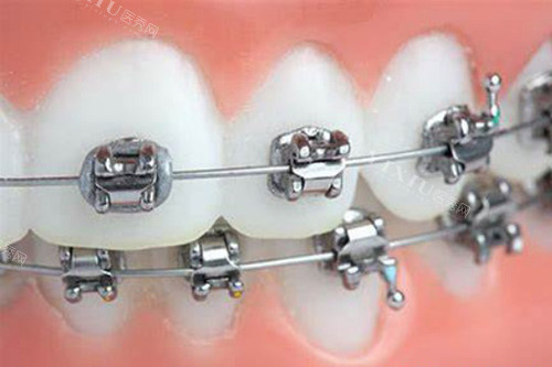 详解牙齿矫正的好处与弊端，想做牙齿矫正这几点一定要注意！(图3)