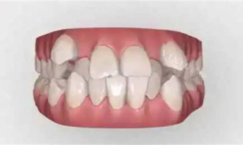 详解牙齿矫正的好处与弊端，想做牙齿矫正这几点一定要注意！(图1)