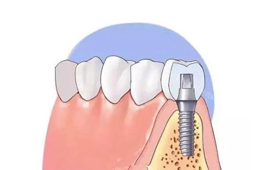 更新2024年景德镇种植牙多少钱？价格表分享，各种材料做种植详细收费！(图1)