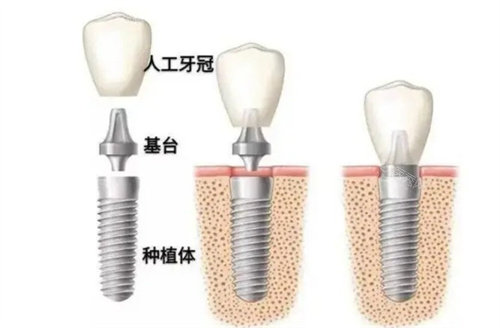 樟木头镇种植牙哪家好？南芳／天使／益佳／廖远宽／詹喜明／缪忠存是靠谱选择！(图3)