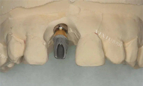 莱顿种植体怎么样，做种植牙优势特点有哪些价格一般是多少？(图1)