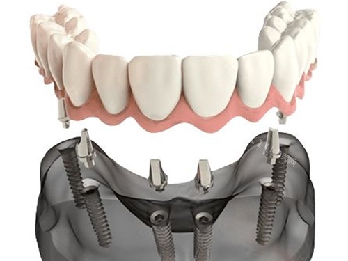 康盛种植体价格3000元起！材质不错／生物相容性好／强度高／型号多样等都是优势！(图3)
