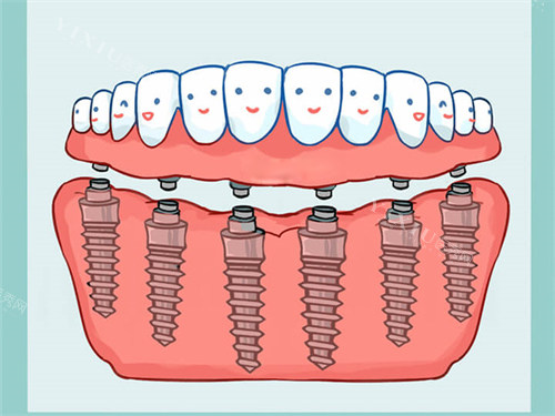 康盛种植体价格3000元起！材质不错／生物相容性好／强度高／型号多样等都是优势！(图1)