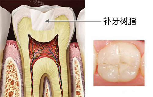 补牙树脂结果图