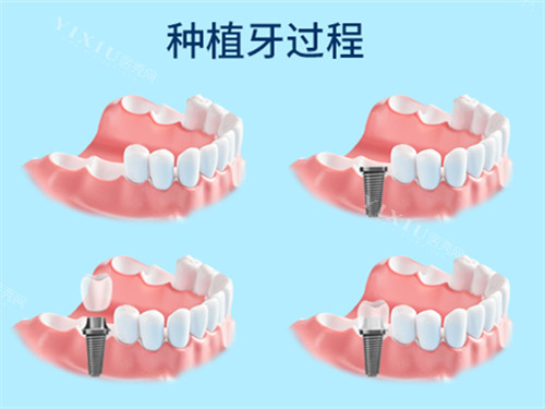 种植牙过程漫画示意图