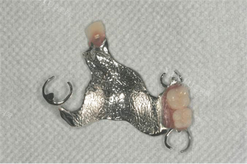 多颗可摘局部义齿实物图