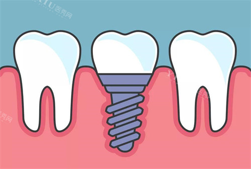 种植牙植入后漫画示意图