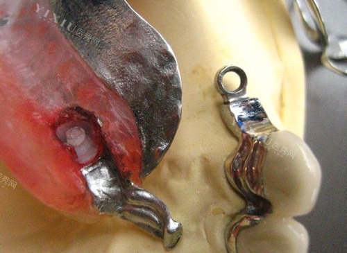 维他灵支架是什么材料,做牙齿修复收费贵吗特点有哪些?