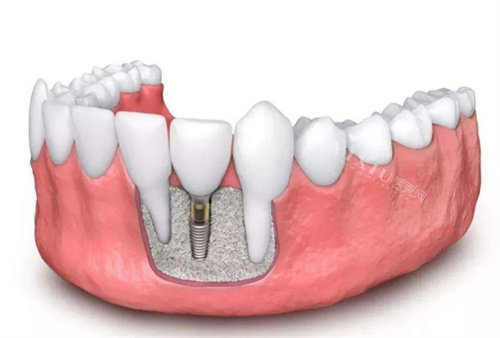 种植牙示意图