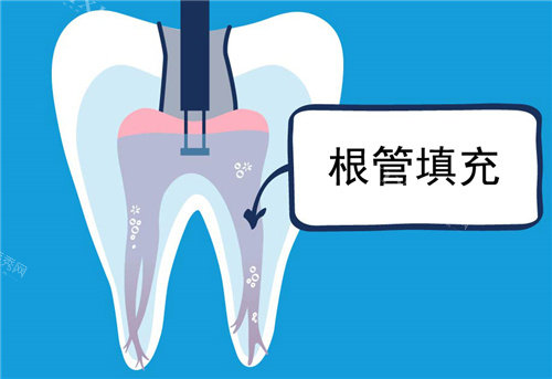 根管填充图示