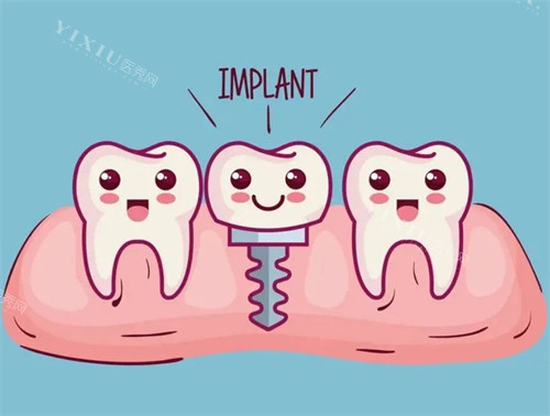种植牙漫画示意图