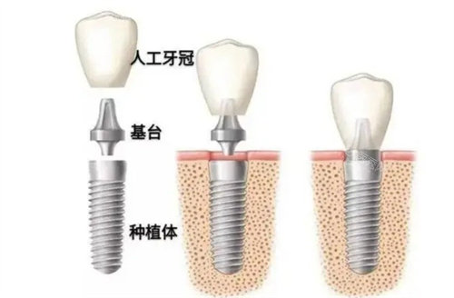 种植牙的结构