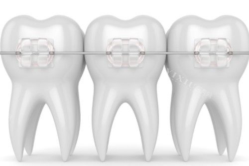 普特单晶陶瓷矫正器怎么样有哪些优势？美观隐形／舒适度高／生物相容性好／治疗周期短！(图1)