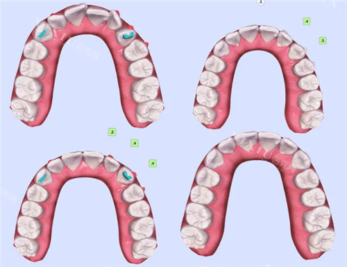 牙齿矫正模拟结果对比