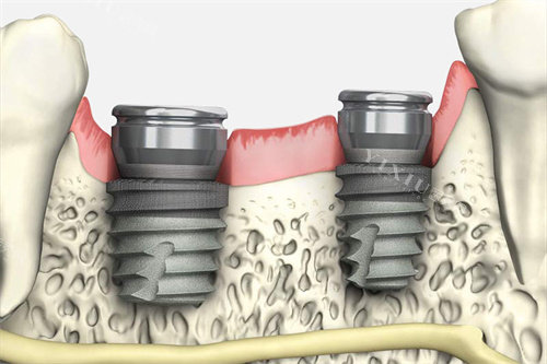 韩国多普勒种植体型号特点分享，质量靠谱收费不贵做牙缺失修复体验好！(图3)