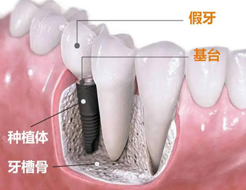 种植牙改善照片图