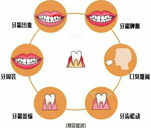 牙周疾病照片