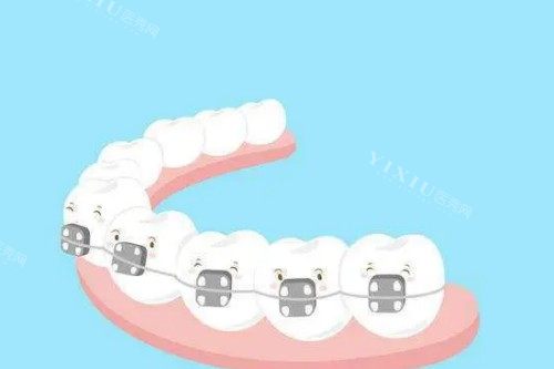 埃蒙迪自锁托槽矫正卡通图