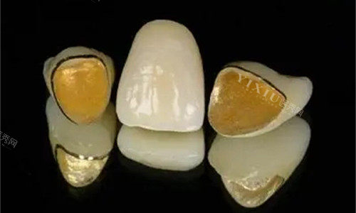 把牙磨小了做烤瓷牙好吗，分享戴牙冠的后遗症和弊端！(图2)